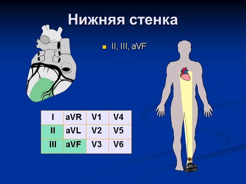 Нижняя стенка II, III, aVF  I II III aVR aVL aVF V1 V2